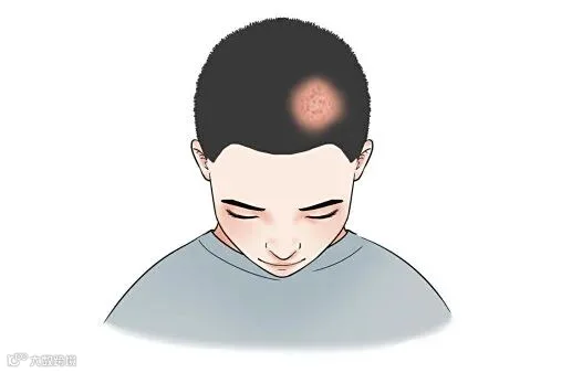 摄图网_401807881_脱发的分类医疗插画（企业商用）.jpg