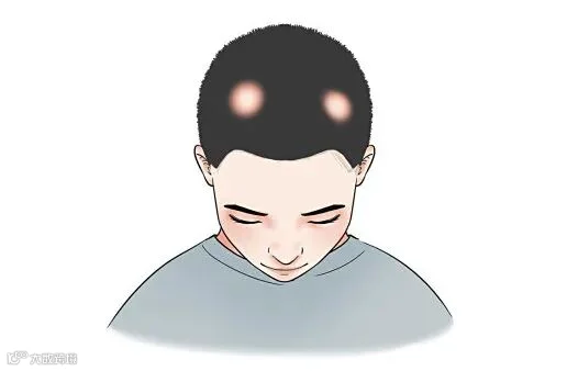 摄图网_401807881_脱发的分类医疗插画（企业商用）.jpg