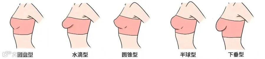 胸部类型去水印.png