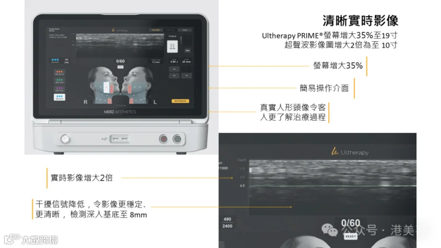 Ultherapy PRIME points