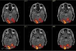 fMRI(功能性磁共振成像) - 知乎