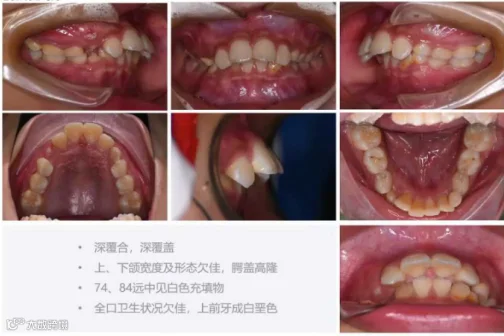 初诊口内照